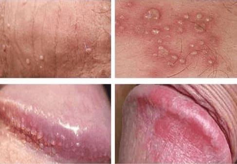 Viêm nhiễm nam khoa nguy hiểm tới mức nào?