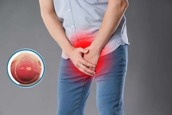 Biểu hiện viêm nhiễm nam khoa xuất hiện do đâu?