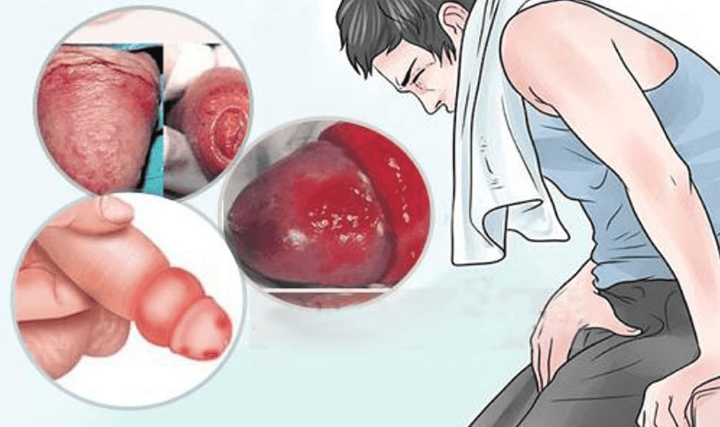 Chi tiết các bệnh viêm nhiễm nam khoa thường gặp