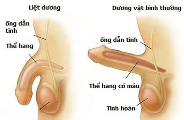 Bệnh liệt dương ở nam giới 