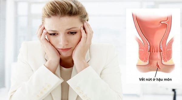 Điều trị nứt kẽ hậu môn bằng đông y hiệu quả như thế nào?