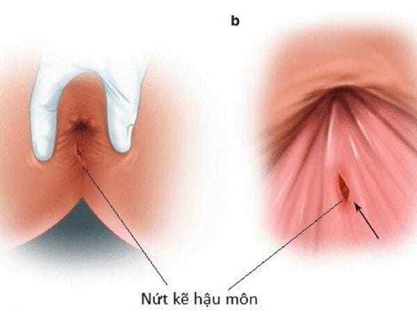 Bệnh lý nứt kẽ hậu môn