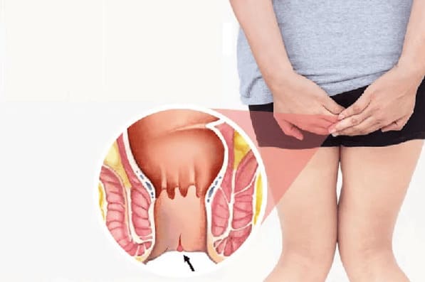 Bệnh nứt kẽ hậu môn