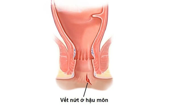 Bệnh lý nứt kẽ hậu môn