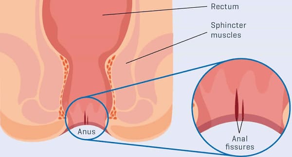 Bệnh nứt kẽ hậu môn