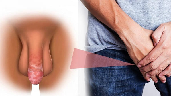 Bệnh viêm nhiễm nam khoa thường gặp - Viêm bao quy đầu