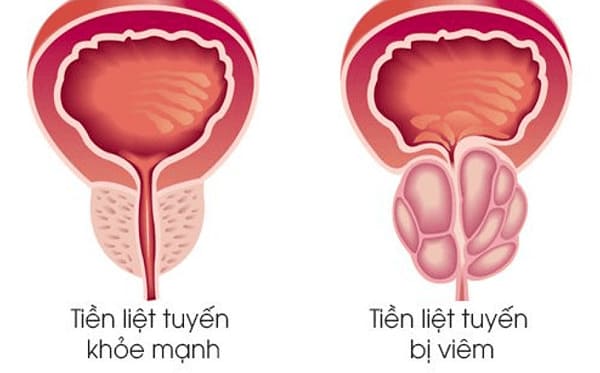 Viêm tuyến tiền liệt