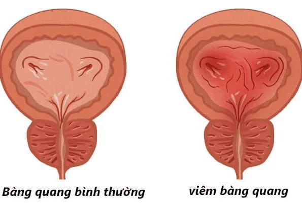 Viêm bàng quang