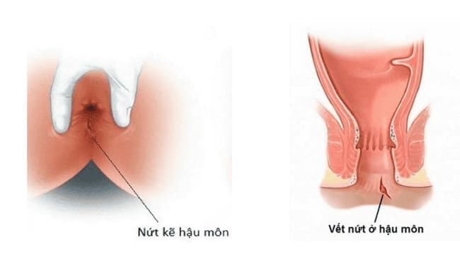 Nguyên nhân gây bệnh nứt kẽ hậu môn