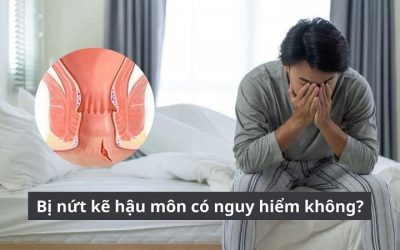 Bị nứt kẽ hậu môn có nguy hiểm không? Cảnh báo biến chứng thầm lặng