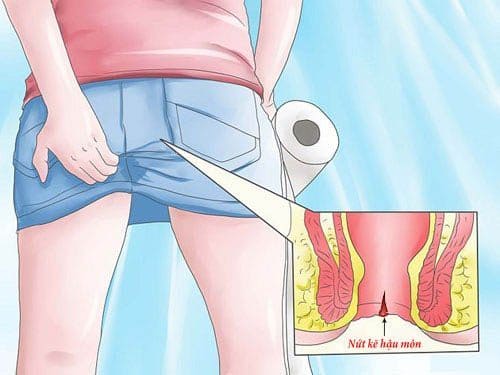 Nứt kẽ hậu môn liệu có thể tự khỏi??
