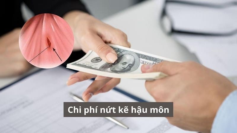 Hiểu đúng chi phí nứt kẽ hậu môn để điều trị an toàn và tiết kiệm