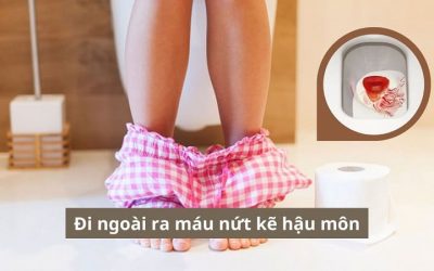 [Cảnh báo] Đi ngoài ra máu nứt kẽ hậu môn cần cẩn trọng với những rủi ro
