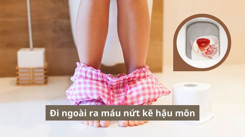 [Cảnh báo] Đi ngoài ra máu nứt kẽ hậu môn cần cẩn trọng với những rủi ro