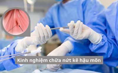 Tổng hợp kinh nghiệm chữa nứt kẽ hậu môn giúp điều trị khỏi chỉ 1 lần