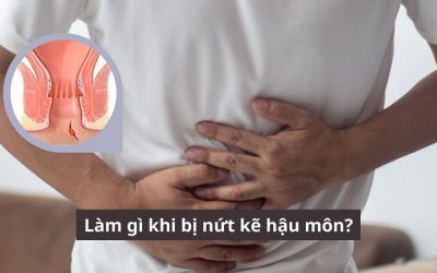 [Giải đáp thắc mắc] Nên làm gì khi bị nứt kẽ hậu môn?