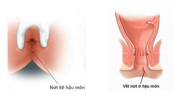Một số nguyên nhân gây nứt kẽ hậu môn hay gặp nhất