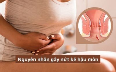 Nguyên nhân gây nứt kẽ hậu môn & cách khắc phục hiệu quả