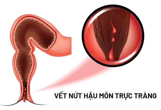 Tìm hiểu rõ về bệnh nứt kẽ hậu môn