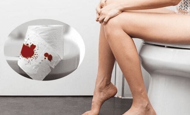 Liệu nứt kẽ hậu môn chảy máu có sao không?