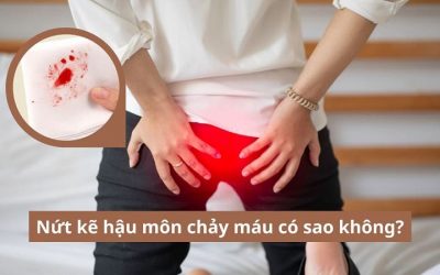 Gỡ rối băn khoăn: Nứt kẽ hậu môn chảy máu có sao không?