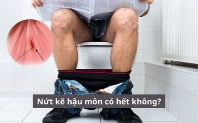 Nứt kẽ hậu môn có hết không? Phương pháp điều trị nào an toàn?