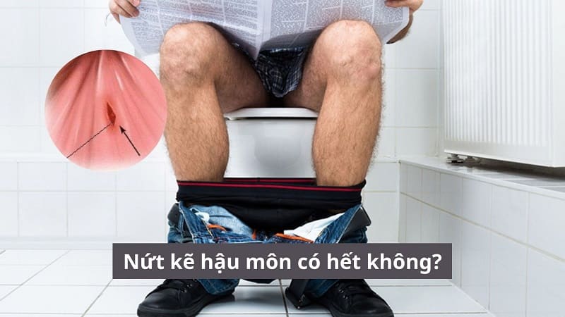 Nứt kẽ hậu môn có hết không? Phương pháp điều trị nào an toàn?