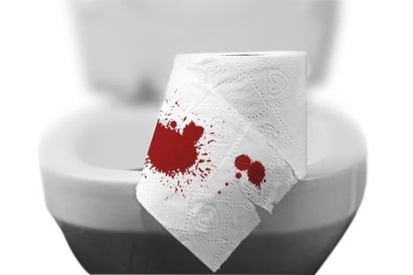 Biến chứng nứt kẽ hậu môn ở phụ nữ sau sinh