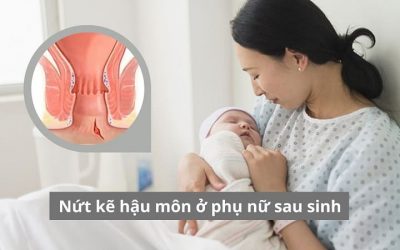 Cảnh báo nứt kẽ hậu môn ở phụ nữ sau sinh & cách chữa