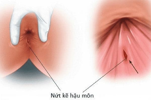 Nứt kẽ hậu môn là gì?