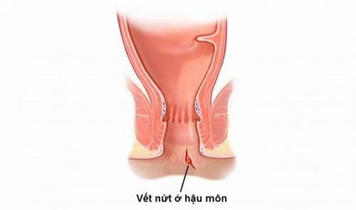 Nứt kẽ hậu môn có phải bệnh nguy hiểm không?