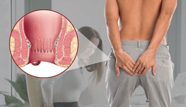 Các triệu chứng bệnh trĩ sẽ xuất hiện trong bao lâu?