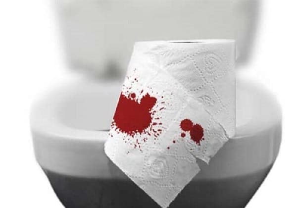 Triệu chứng bệnh trĩ: Chảy máu khi đại tiện