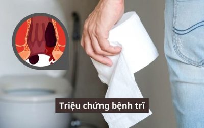 Cảnh giác với những triệu chứng bệnh trĩ dễ nhận biết!