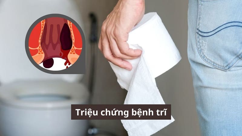 Cảnh giác với những triệu chứng bệnh trĩ dễ nhận biết!