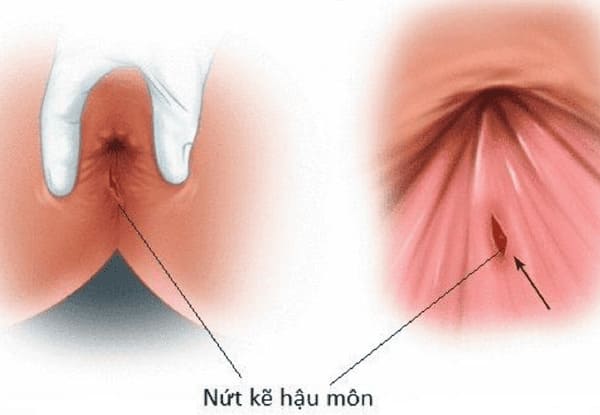 Vì sao cần vệ sinh hậu môn khi bị nứt kẽ đúng cách? 