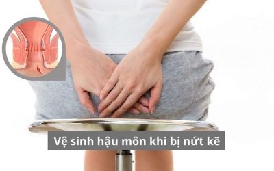 Vệ sinh hậu môn khi bị nứt kẽ: Cách làm lành nhanh và ngừa tái phát