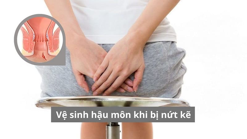 Vệ sinh hậu môn khi bị nứt kẽ: Cách làm lành nhanh và ngừa tái phát